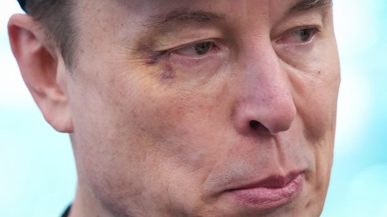 Elon Musk sports black eye at farewell presser in Oval Office: ‘Horsing around with little X’
